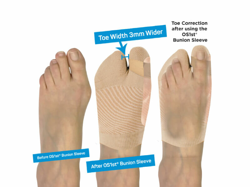 Uitleg werking HV3 hallux valgus brace