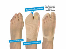 Uitleg werking HV3 hallux valgus brace