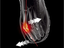 Epitact brace hallux valgus indicatie