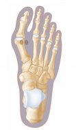 Hallux valgus