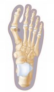 Hallux valgus bunion 