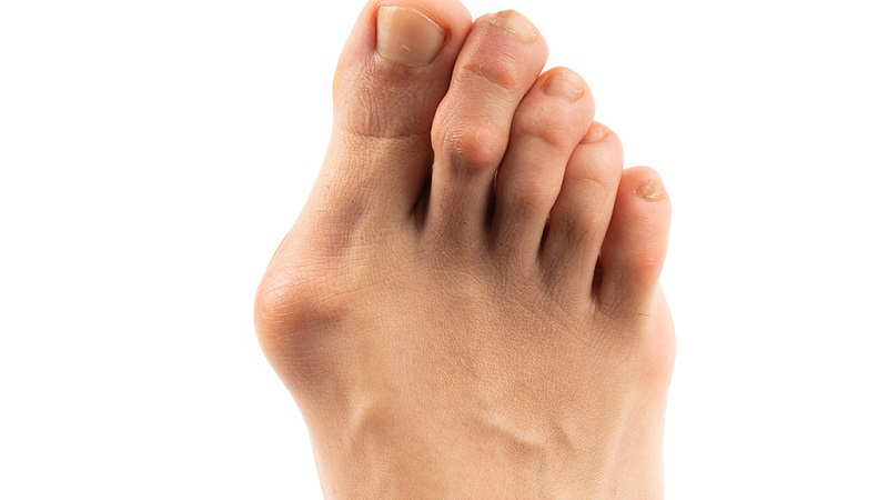 Hallux valgus