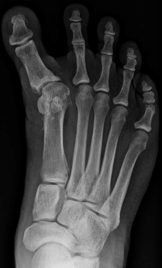 Hallux varus - na operatie