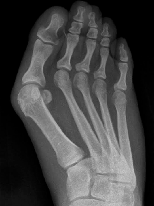 hallux valgus röntgen foto