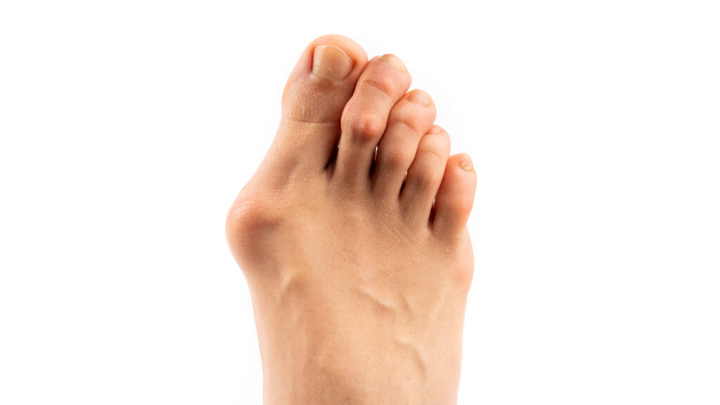 Hallux valgus