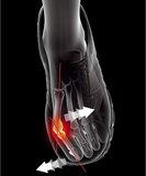 orthese-hallux-valgus (1).JPG