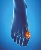 ppotection-hallux-valgus (2).JPG